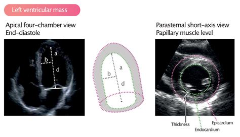 left ventricular cavity size